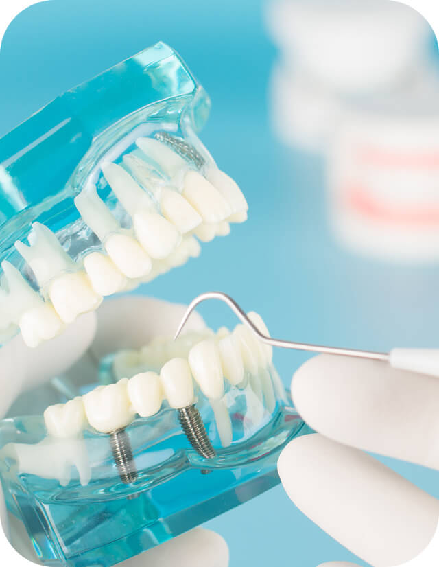 インプラント・移植